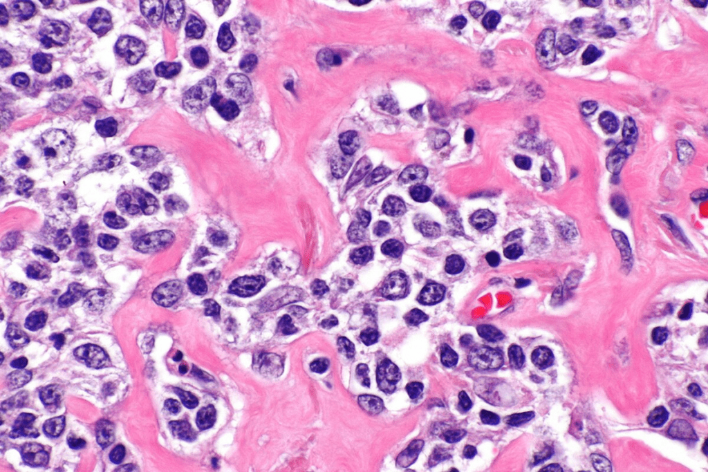 Lymphoma: Crucial Powerful Presentation in Children 2 Lymphoma: Crucial Powerful Presentation in Children