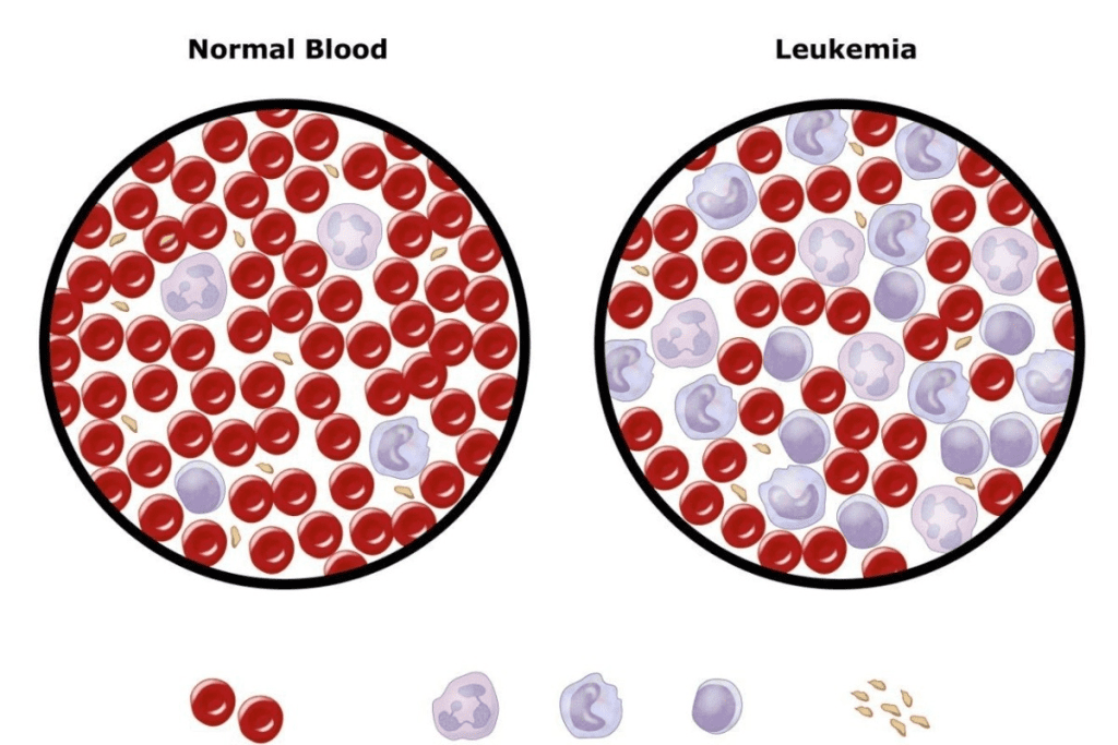 Leukemia Diagnosis: Dangerous Mistaken Conditions