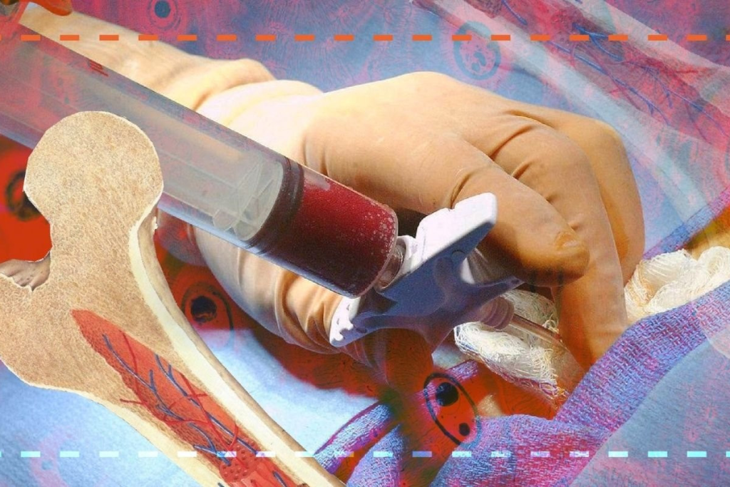 Longevity: life expectancy after stem cell transplant for Leukemia Patients