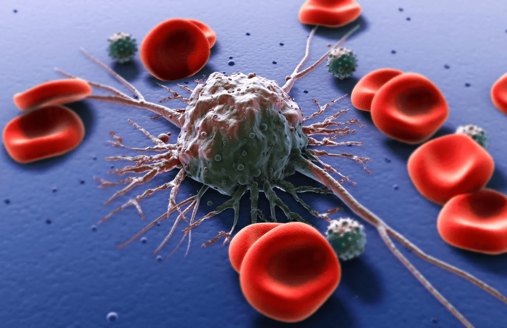 Progression Speed: How Quickly Does Leukemia Advance? leukemia survival rate