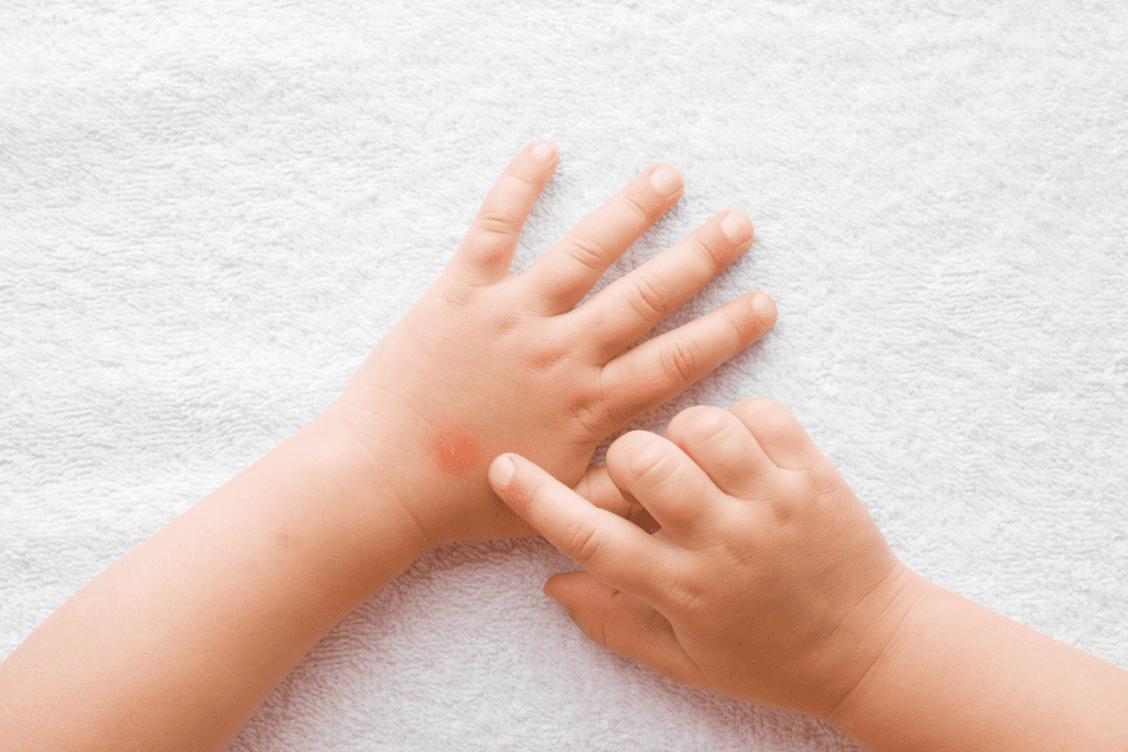 Primary Immune Thrombocytopenia Children