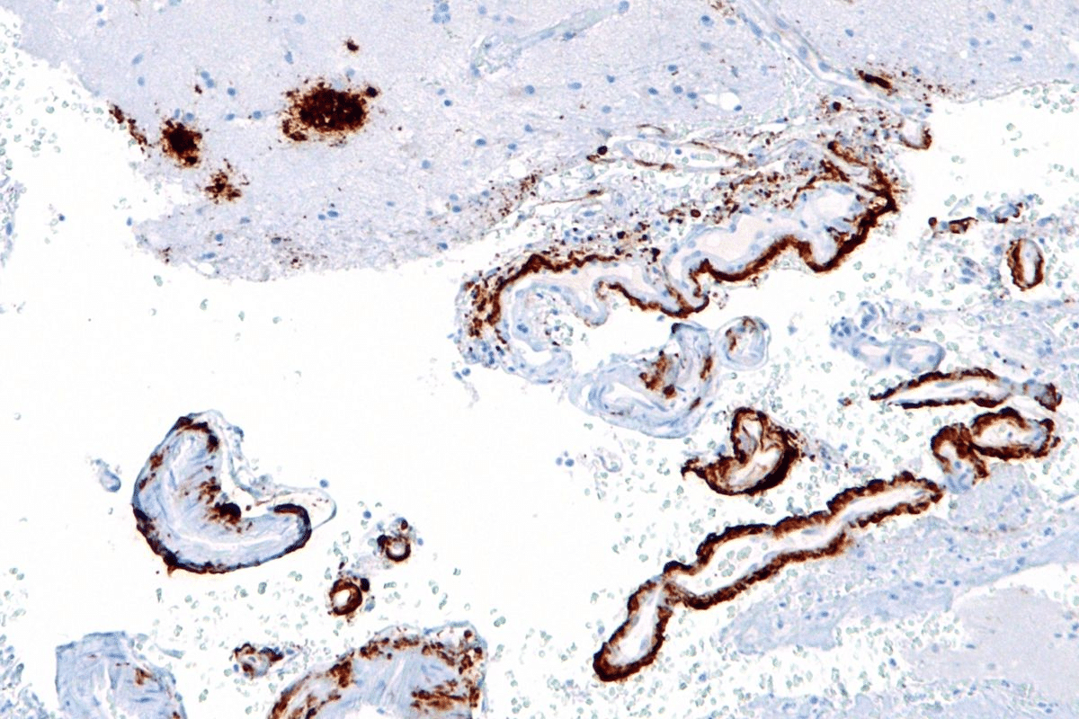 End Stage Cerebral Amyloid Angiopathy 3 End Stage Cerebral Amyloid Angiopathy