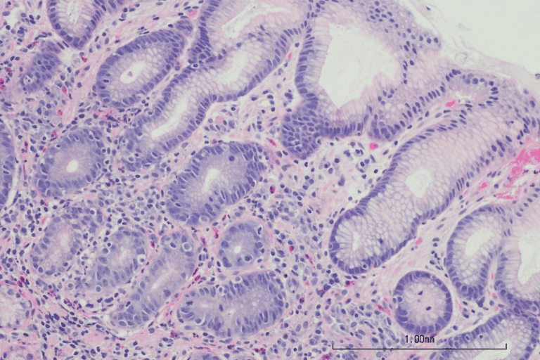 What Is Angiopathy? Best Vital Guide