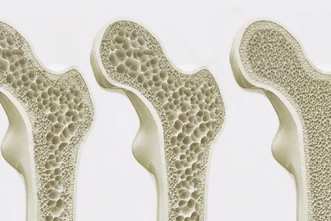 Once a Year Infusion for Osteoporosis