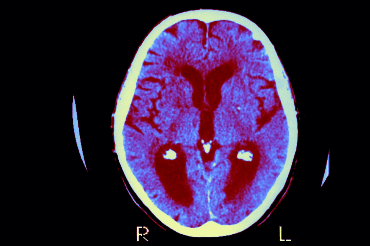 Cerebral Amyloidosis Symptoms: Best Info