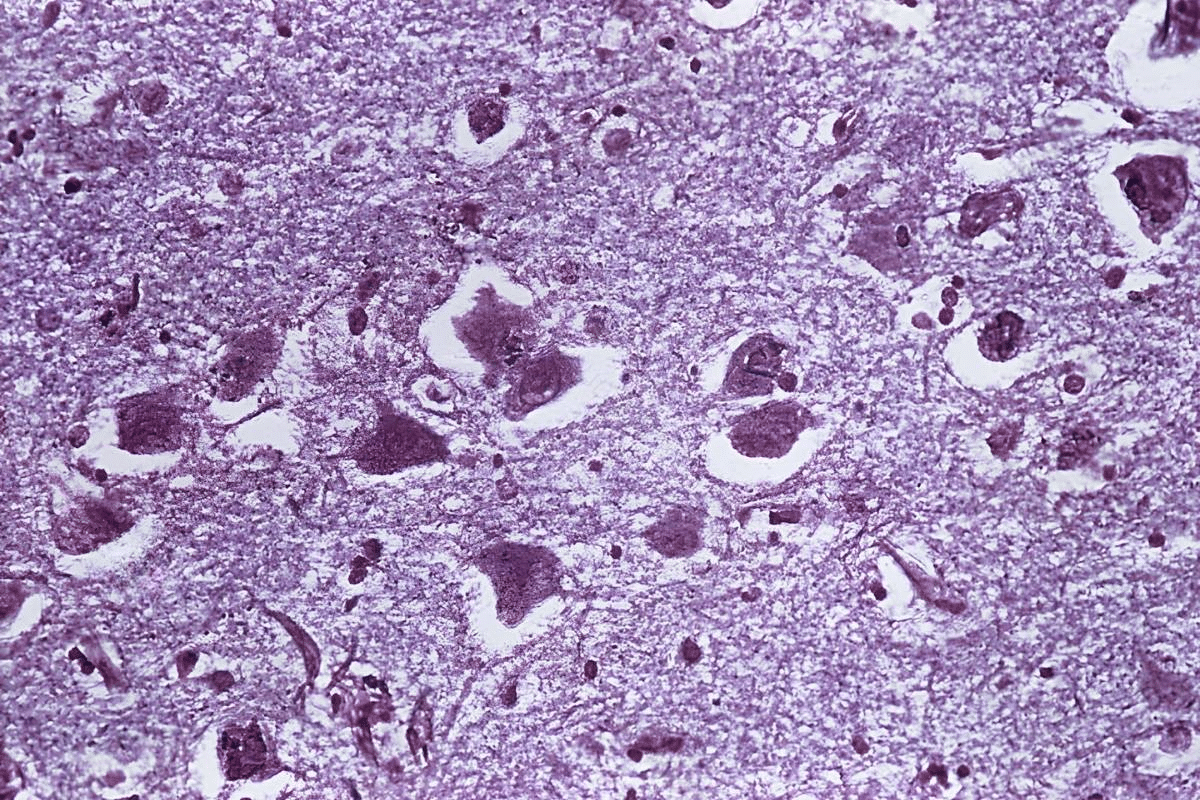 Causes of Lip Smacking in Elderly: Guide