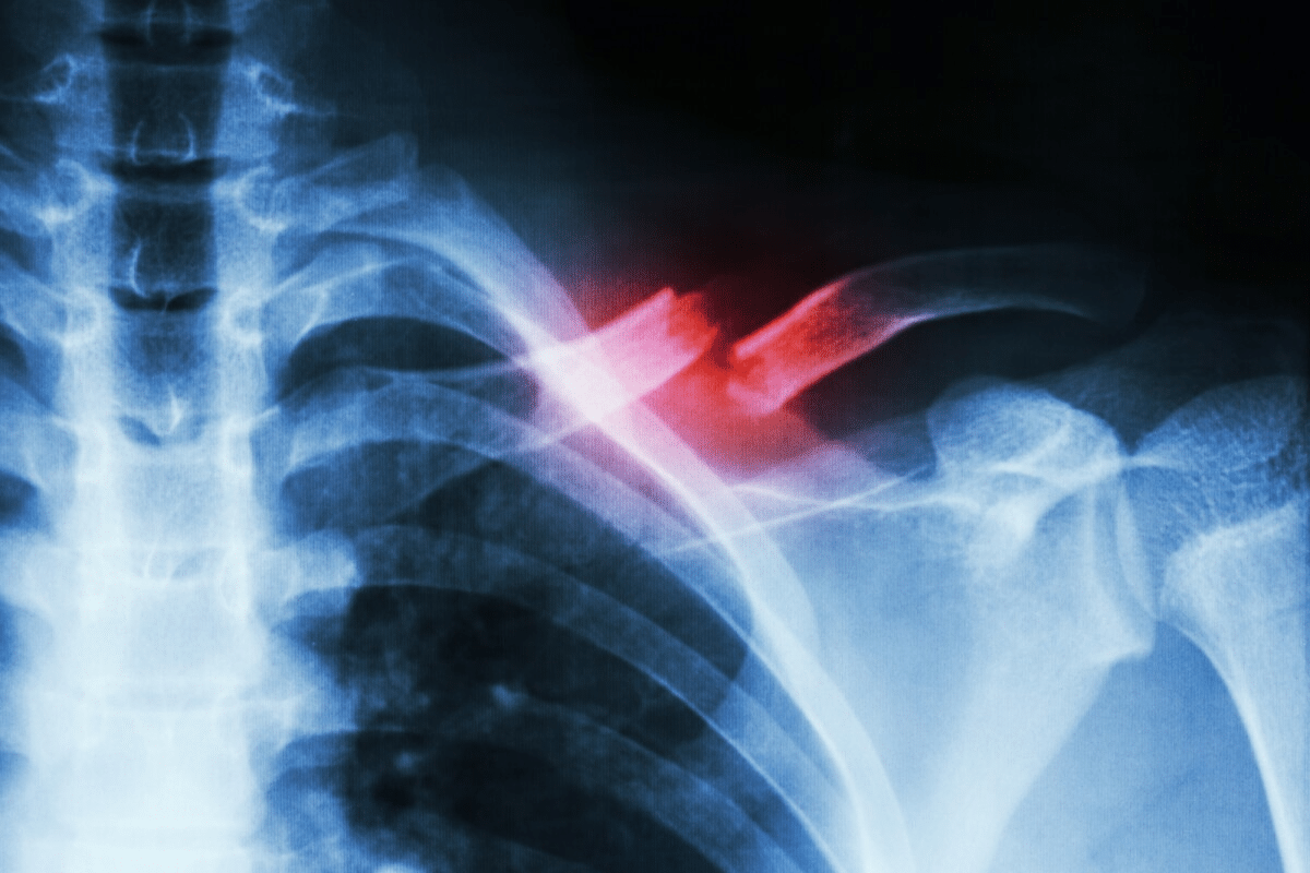 Causes of Fracture: Best Prevention Tips