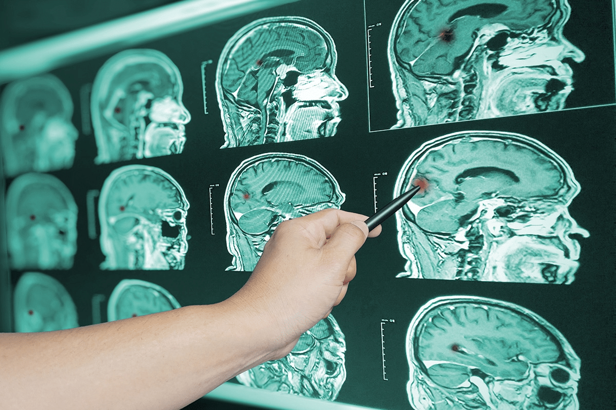 How to Know if You Have Brain Damage?