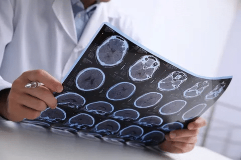 Brain Tangles: Best Alzheimer's Facts