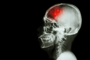 Cerebral Injury Symptoms: Best Guide