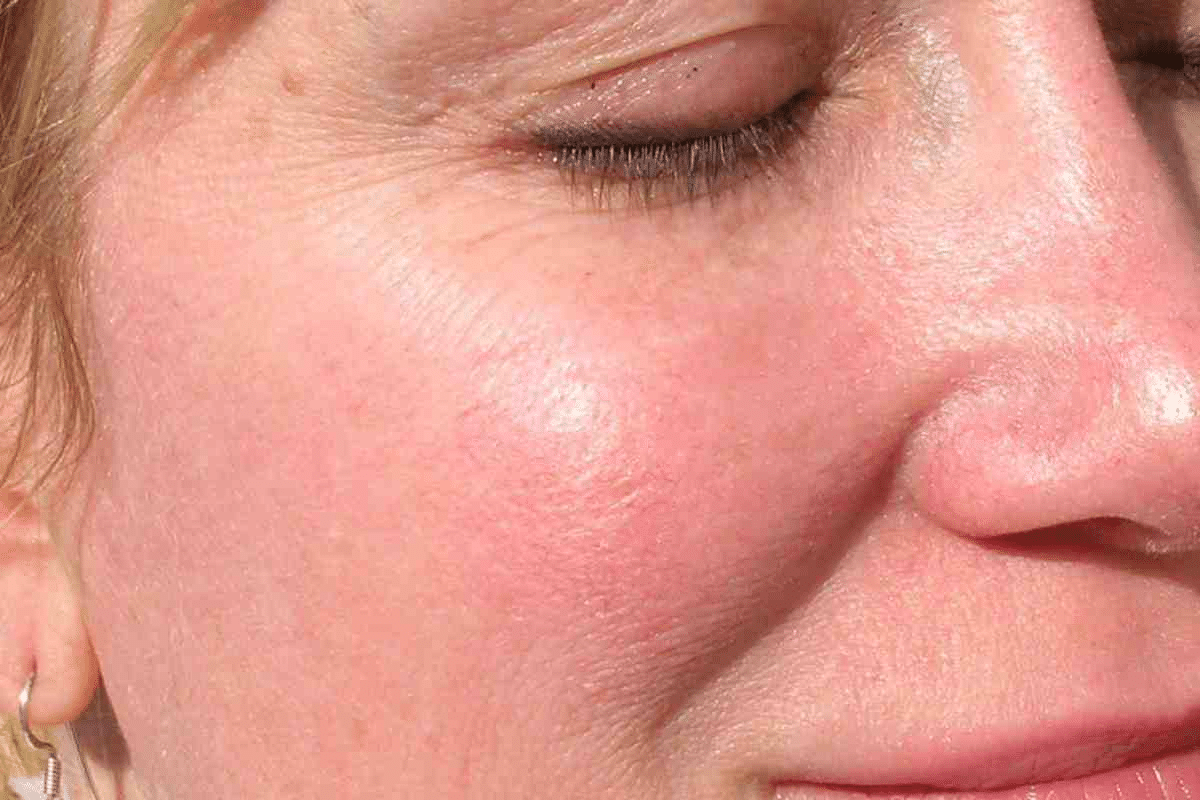 Sharp How Long Do You Live With Lupus: Expectancy