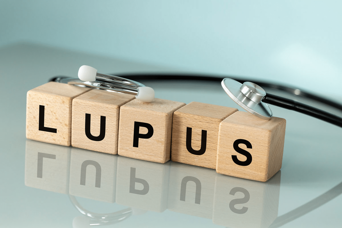 Simple Complete Management Guide: Living With SLE Lupus