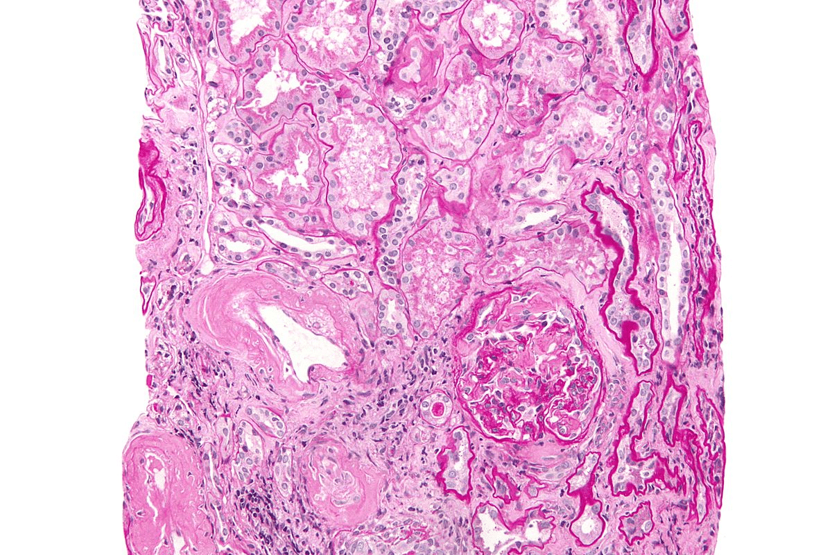 Other Words for Dementia: A Complete List