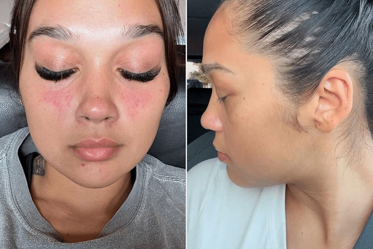 Essential Lifespan Lupus: Life Expectancy Explained