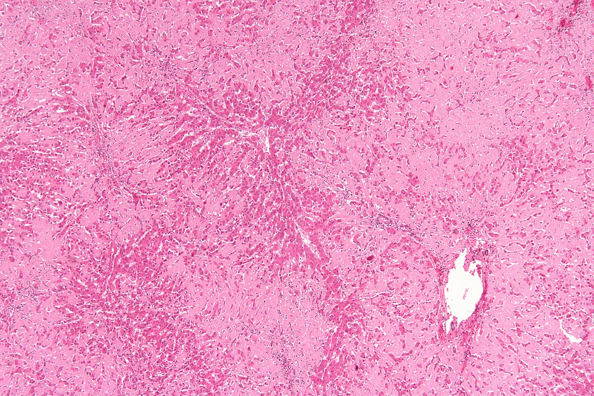 Amyloidosis Medication: The Best Treatment List