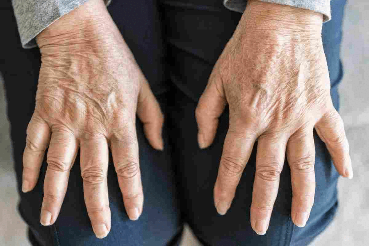 Crucial Do You Die From Rheumatoid Arthritis: Risks Explained