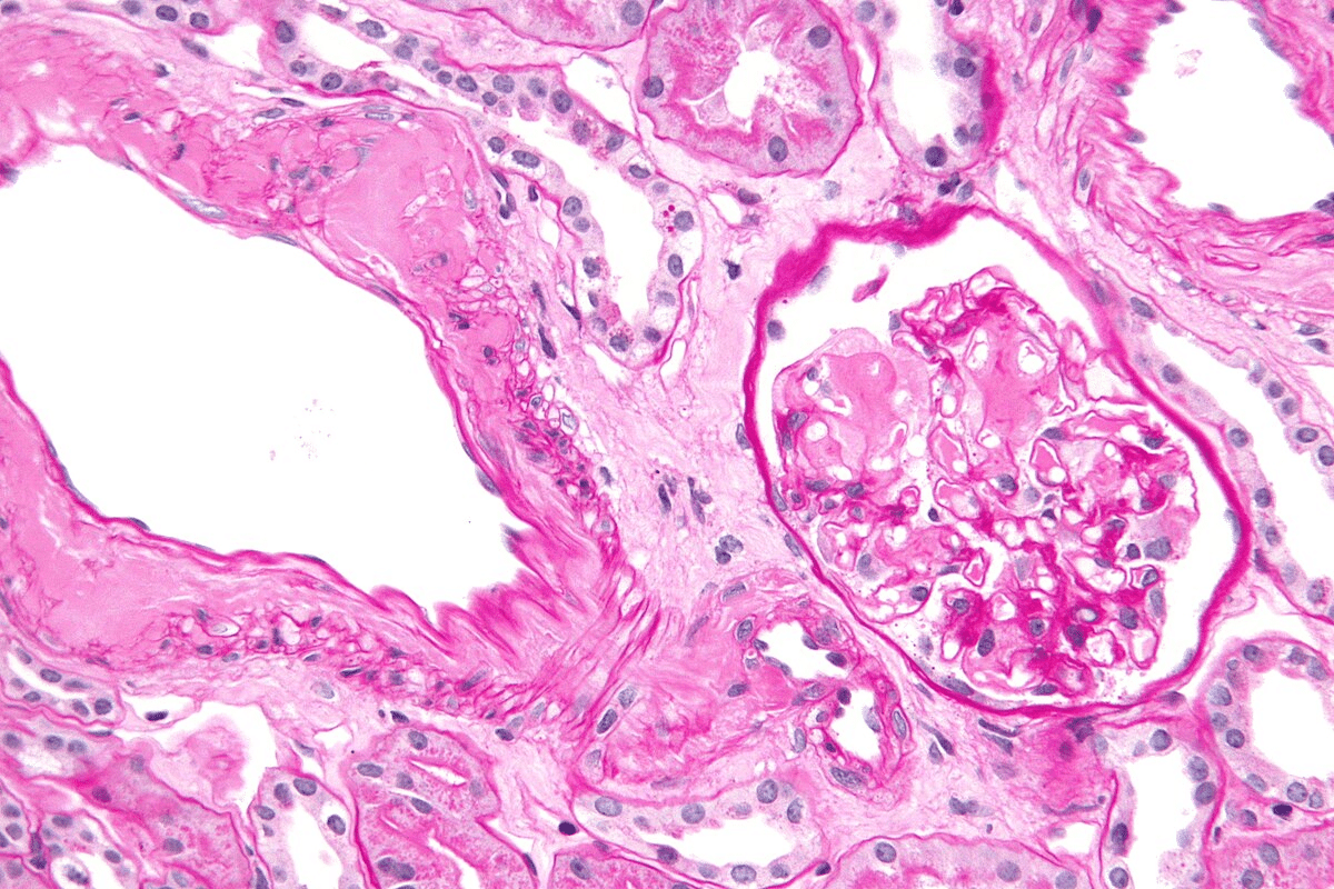 TTR Amyloidosis Symptoms: 5 Warning Signs