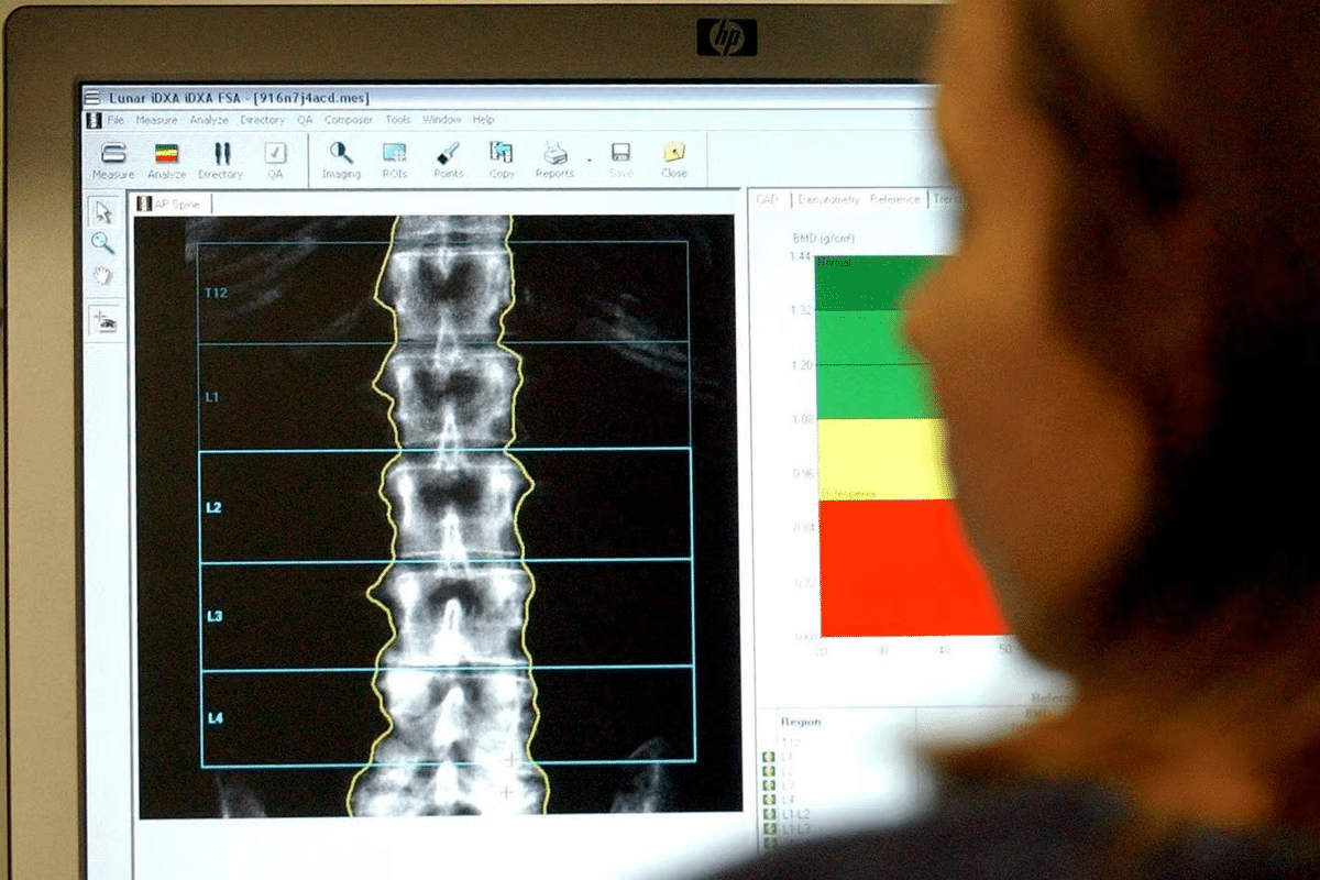 Does a DEXA Scan Show Bone Cancer? 3 Does a DEXA Scan Show Bone Cancer?