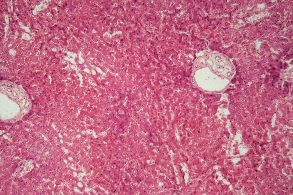 Cardiac Amyloid Symptoms: 5 Key Signs to Watch