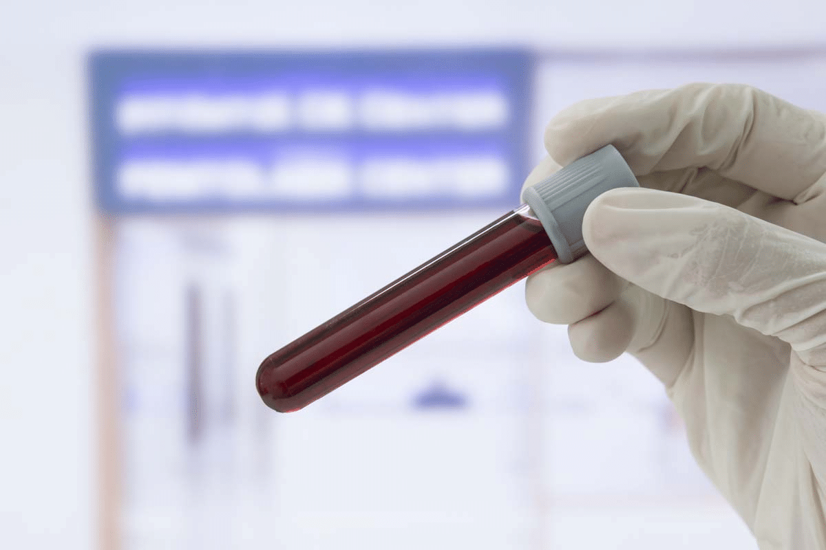 Blood Test for Bone Loss: 5 Essential Labs