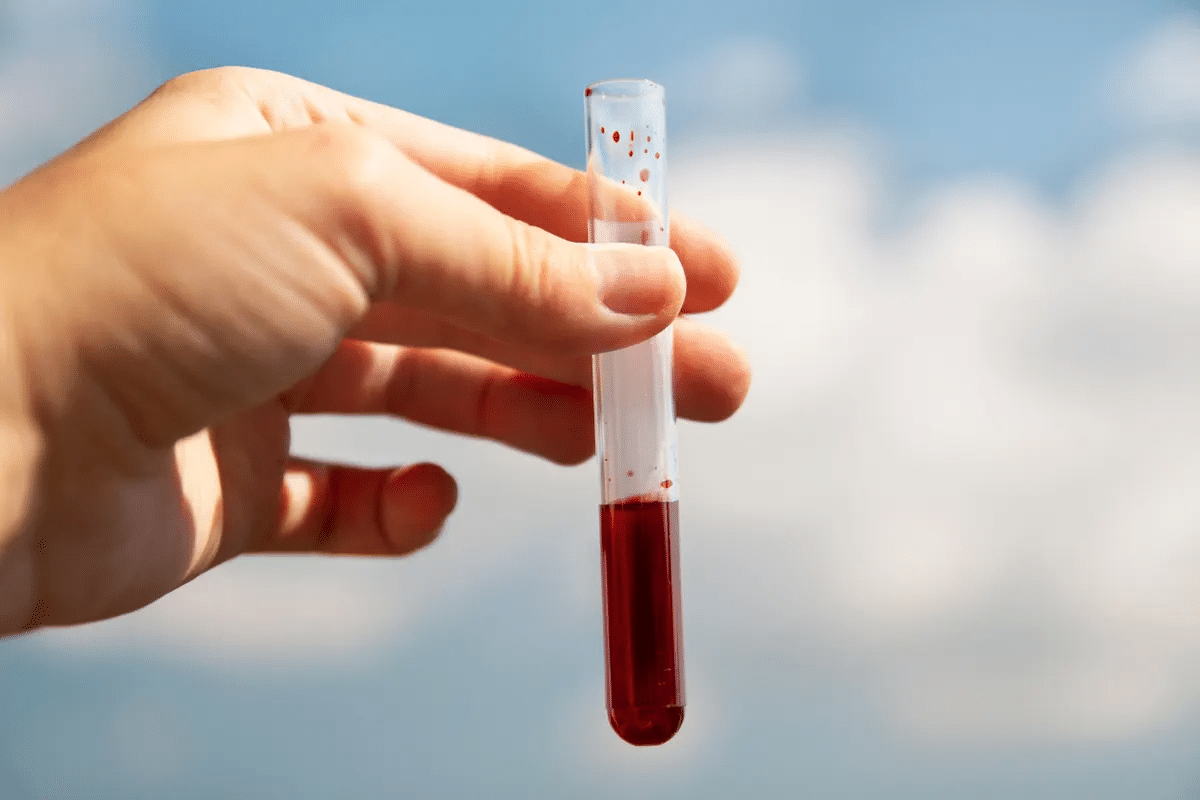 Essential Anti CCP Test Reference Range: Normal Values 3 Essential Anti CCP Test Reference Range: Normal Values