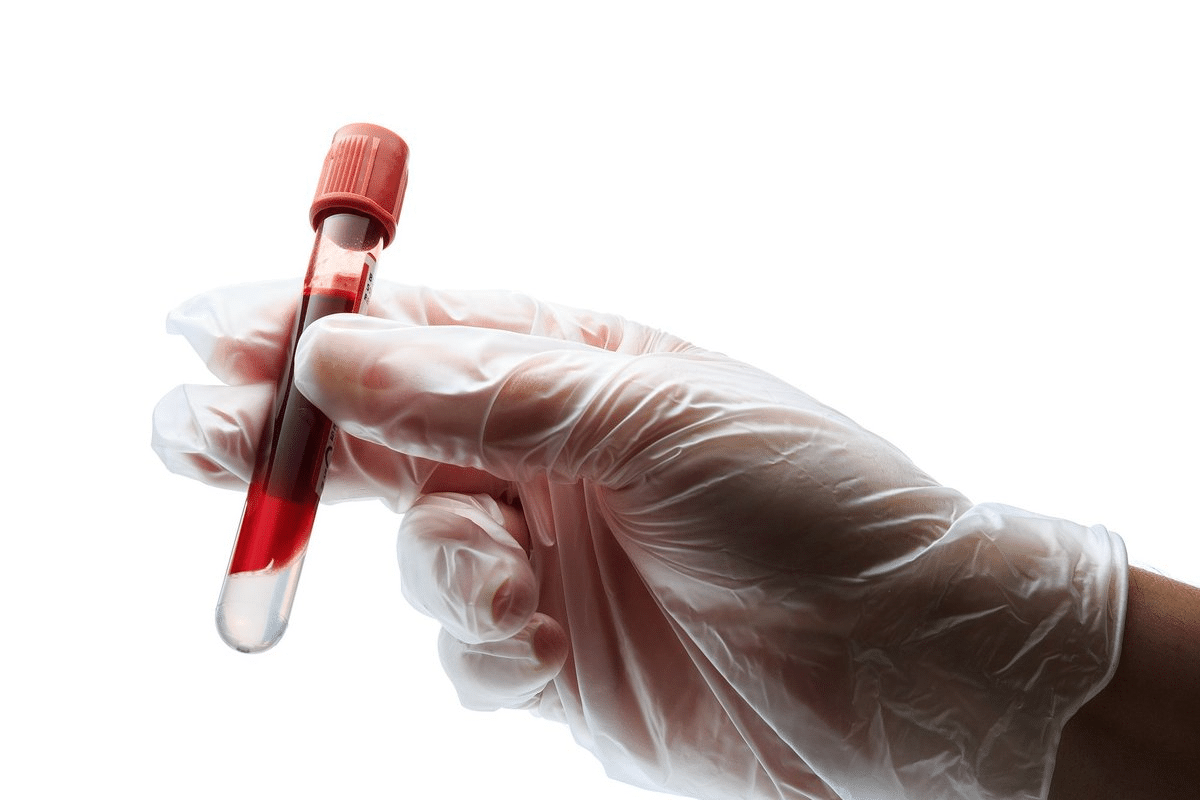 Key Anti CCP AB IGG IGA Test & Results Meaning 2 Key Anti CCP AB IGG IGA Test & Results Meaning