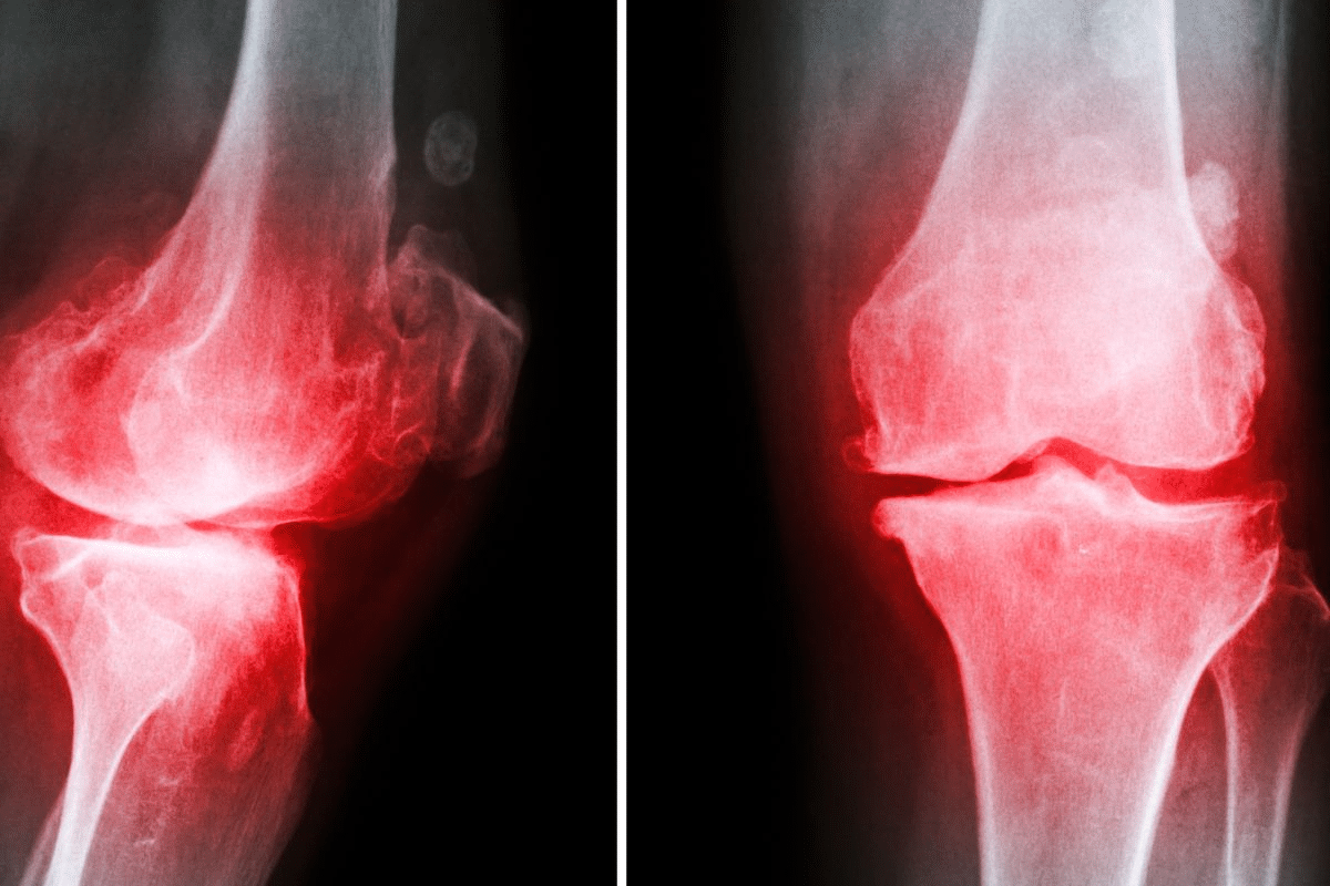 Guide Get Rid Of Inflammatory Joint Disease