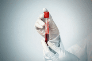 Sharp What Is Cyclic Citrullinated Peptide Blood Test & Results?