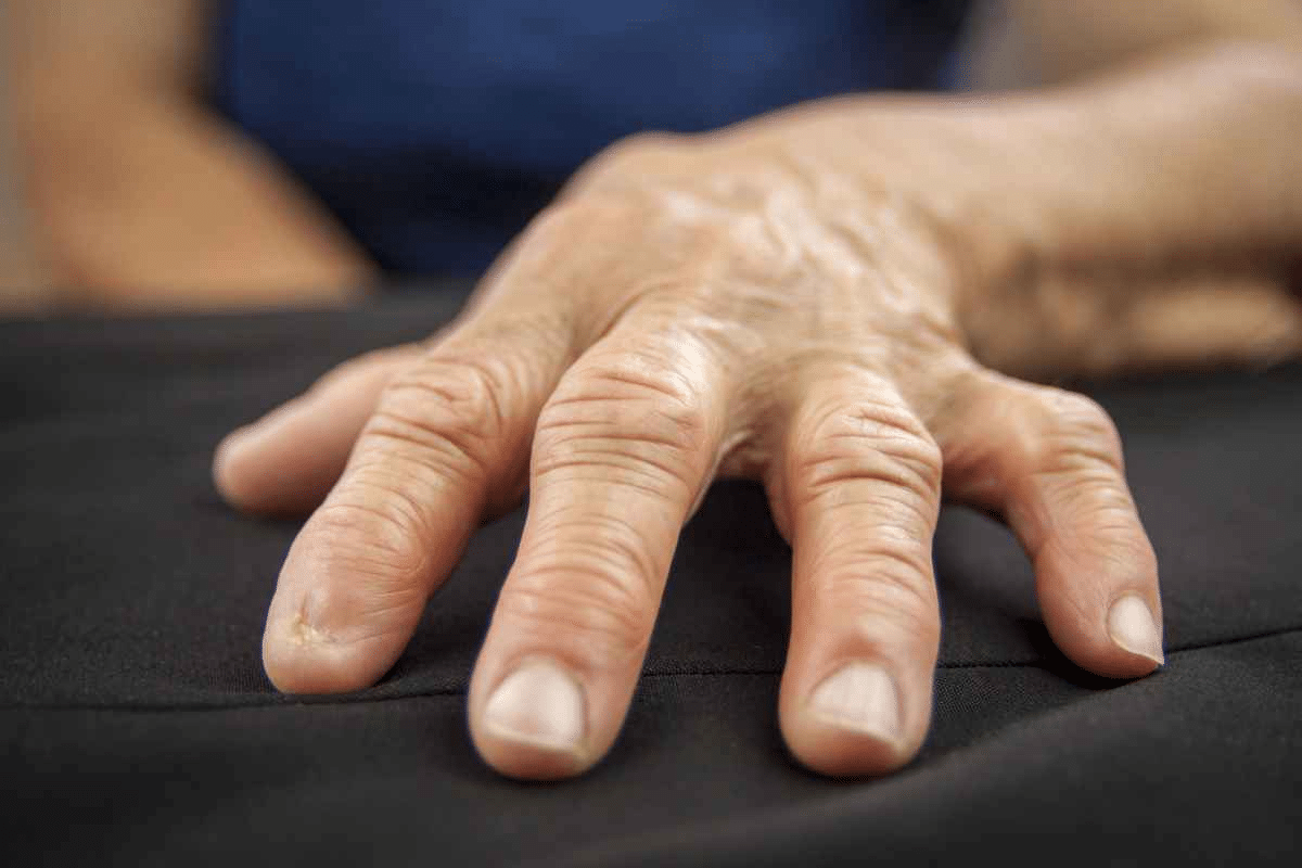 Profound What Triggers Rheumatoid Arthritis Flare Ups?