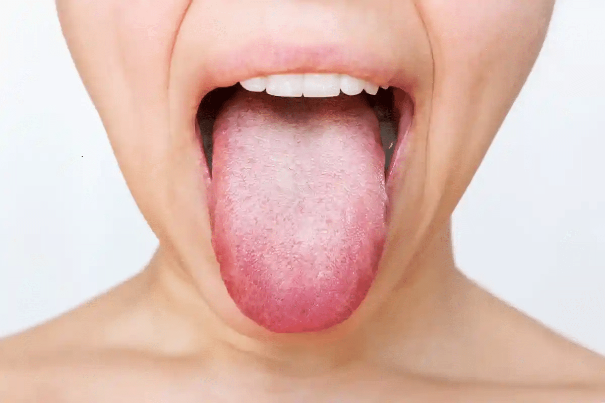 Valuable Can Connective Tissue Disorder Cause Swollen Tonsils?