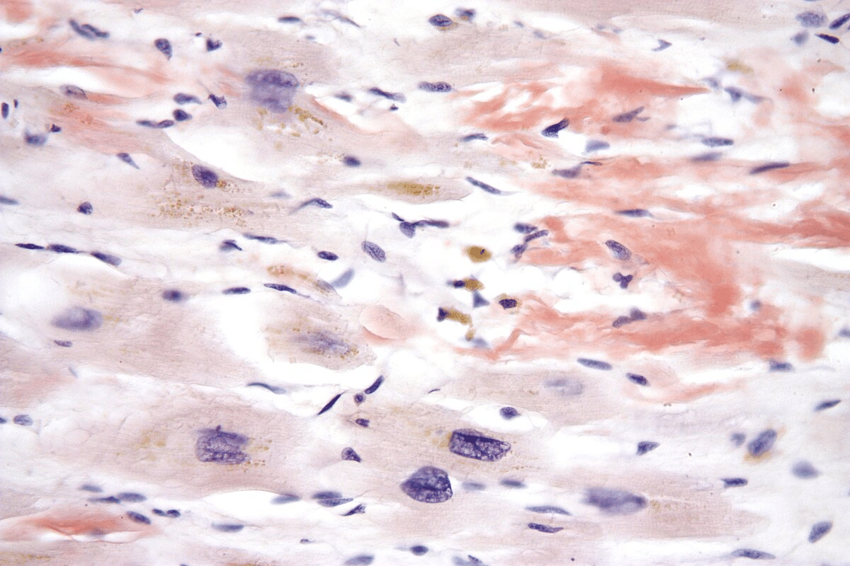 Kappa Light Chain Amyloidosis: Essential Facts - Liv Hospital