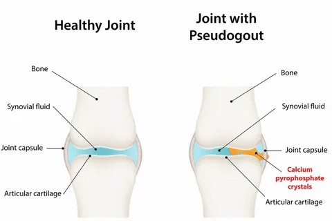 Valuable 5 Essential Facts About CPPD Pseudogout