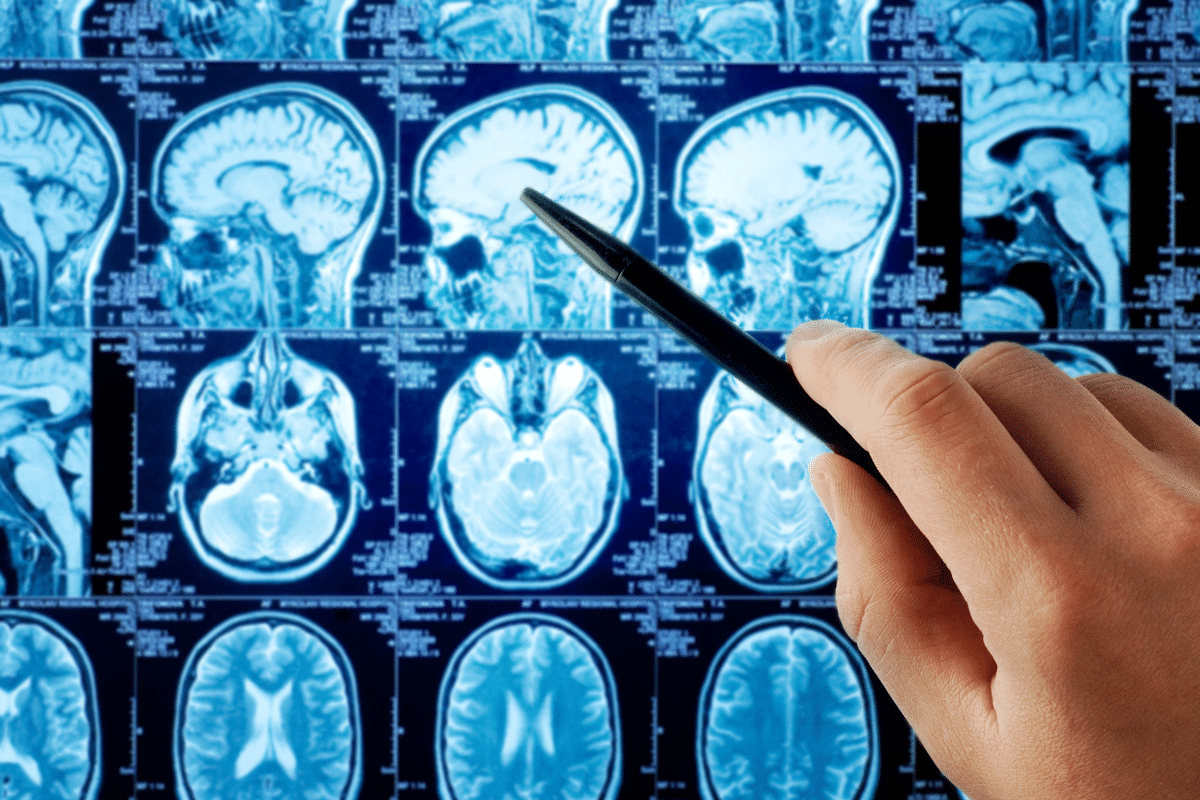 Amnesia Definition: The Essential Meaning