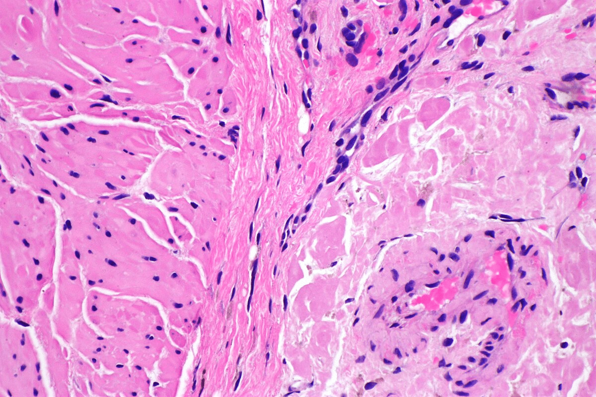 AL Amyloidosis Disease: 5 Dangerous Facts to Know