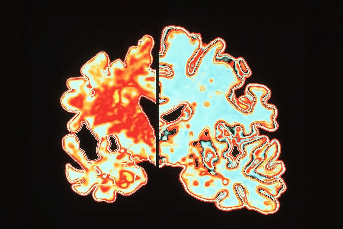 How to Pronounce Alzheimer: The Easy Way