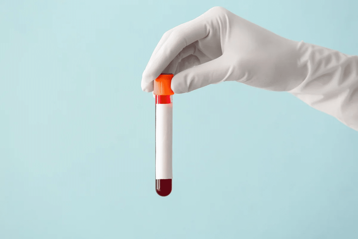 Key Cyclic Citrullinated Peptide AB IGG Test & Results