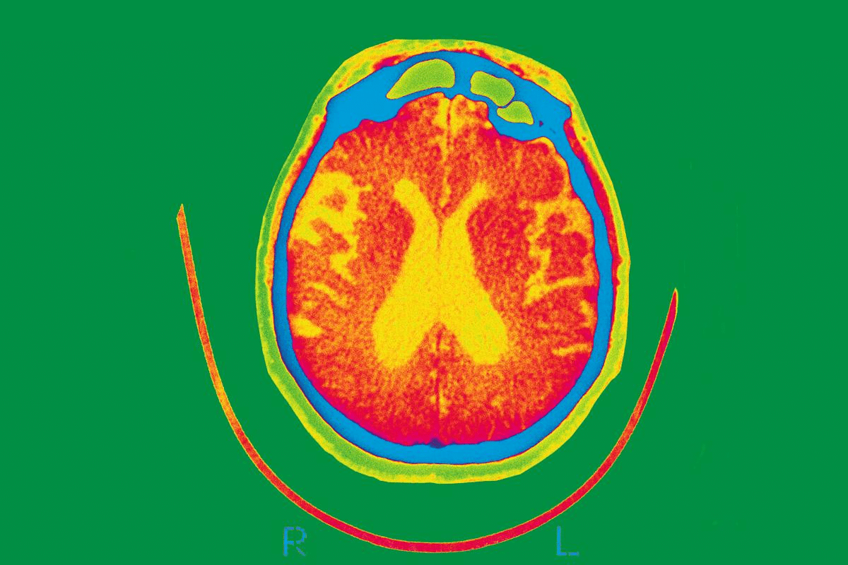 How to Diagnose Alzheimer Disease: Best Guide