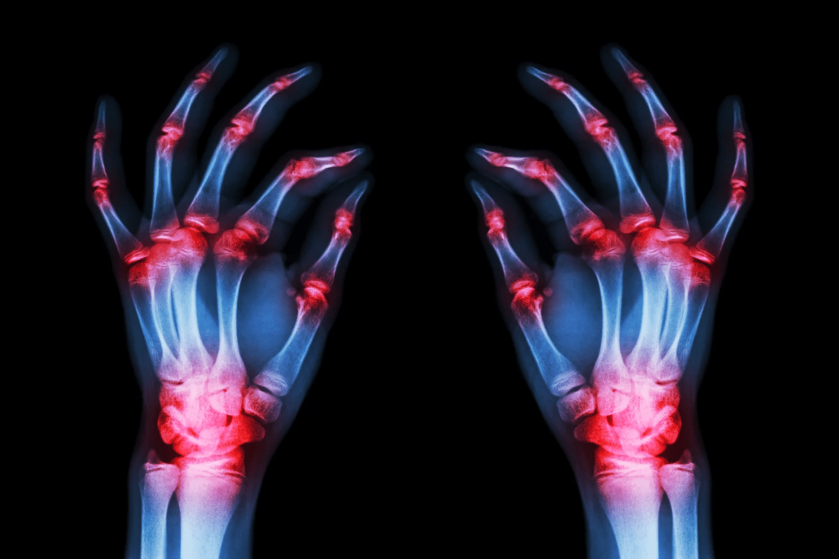 Guide Can X Rays Detect Arthritis: What To Know