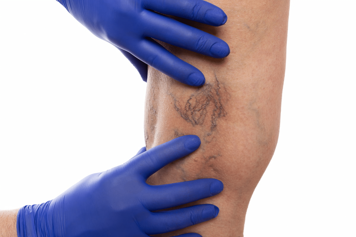 Sharp Do Spider Veins Go Away On Their Own?