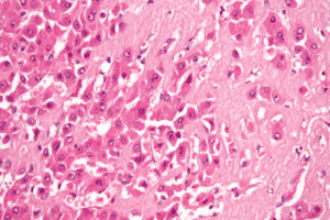 Amyloid Liver Disease: 7 Dangerous Symptoms