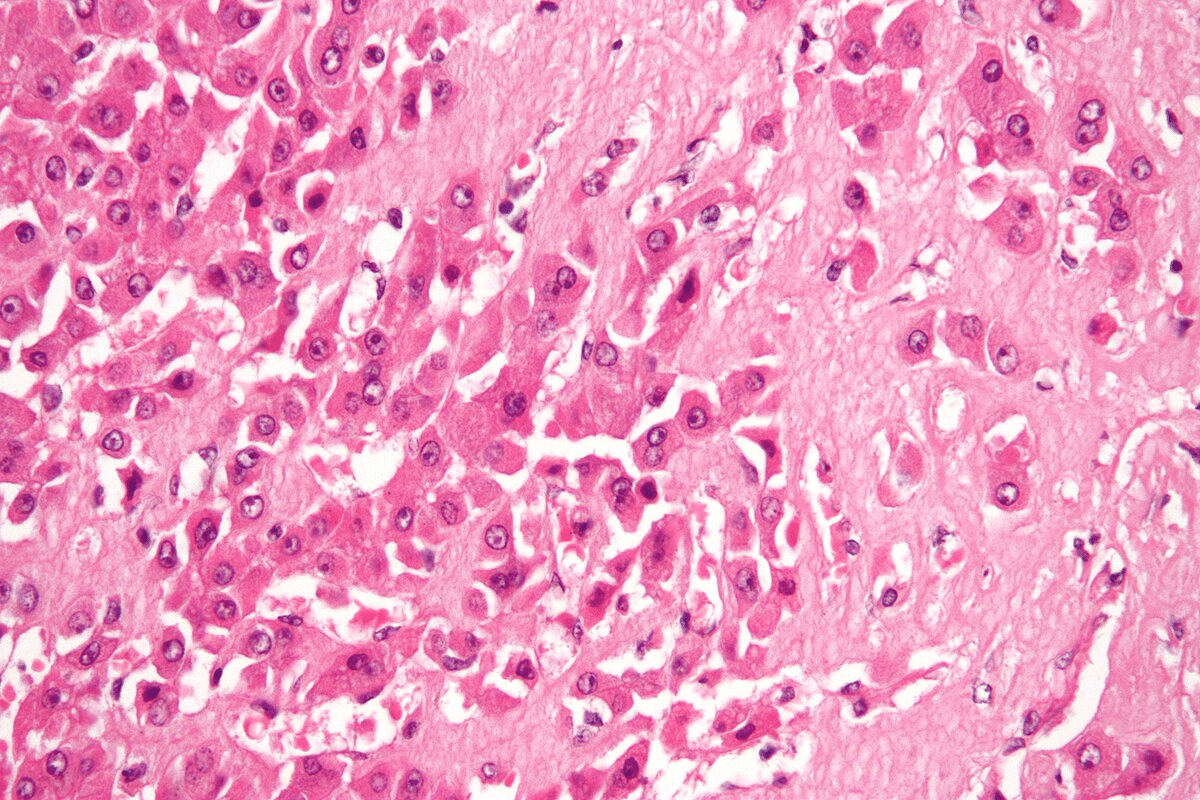 Amyloid Liver Disease: 7 Dangerous Symptoms