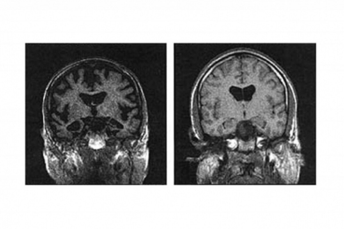 Alzheimer Disease Involves Deterioration of Which of the Following? Amazing Answer 2 Alzheimer Disease Involves Deterioration of Which of the Following? Amazing Answer