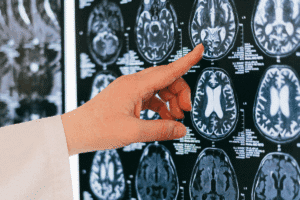 Diagnostic Alzheimer Test: The New Best Options
