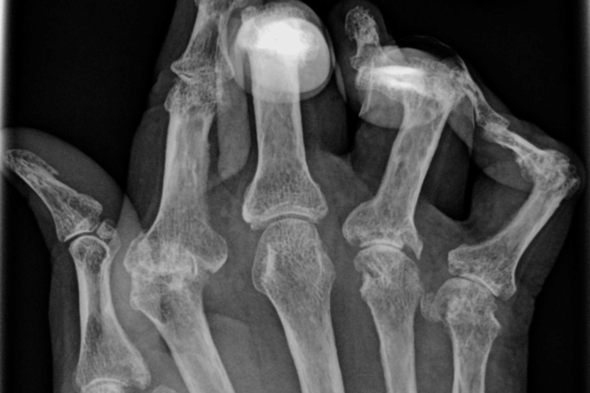 Key Does An MRI Show Arthritis: What To Know 3 Key Does An MRI Show Arthritis: What To Know