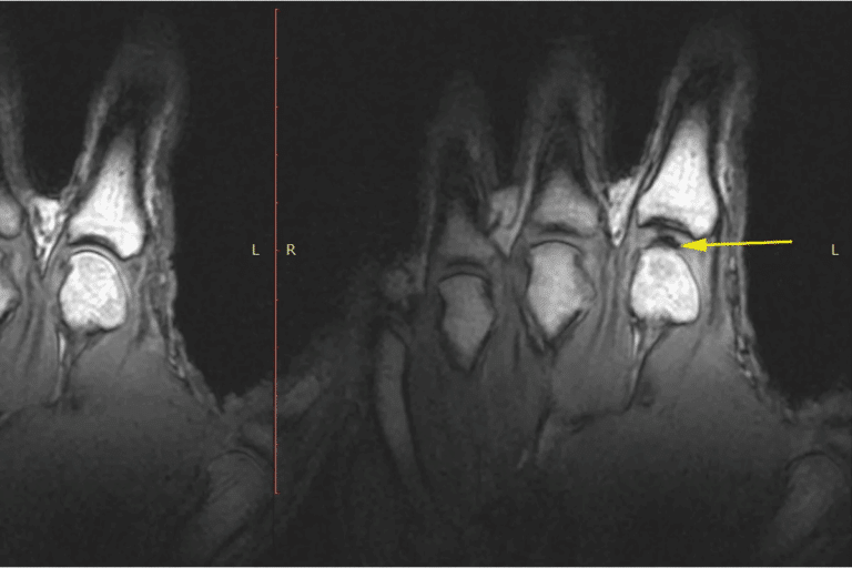 Key Does An MRI Show Arthritis: What To Know
