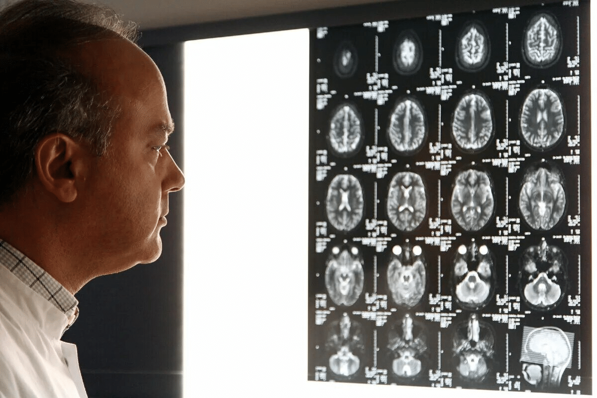 What causes amyloid plaques in the brain? Risks