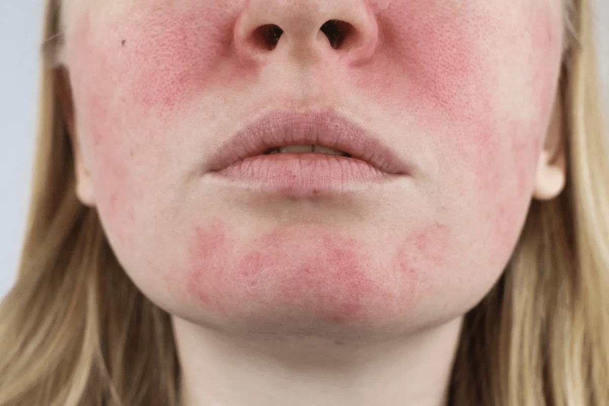 Insightful Types Of Cutaneous Lupus Rashes & Symptoms 2 Insightful Types Of Cutaneous Lupus Rashes & Symptoms