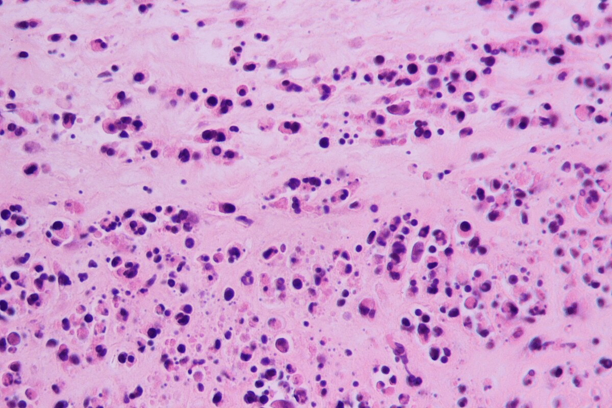 Fascinating What Causes Vasculitis Rash On Legs & Is It Serious? 1 Fascinating What Causes Vasculitis Rash On Legs & Is It Serious?