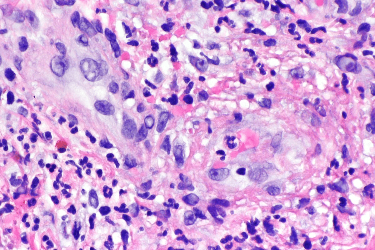 Essential 5 Types Of Small Vessel Vasculitis & Diagnosis