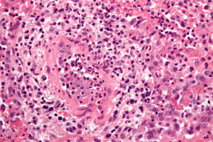 Sharp 5 Key Signs Of Cutaneous Vasculitis Symptoms